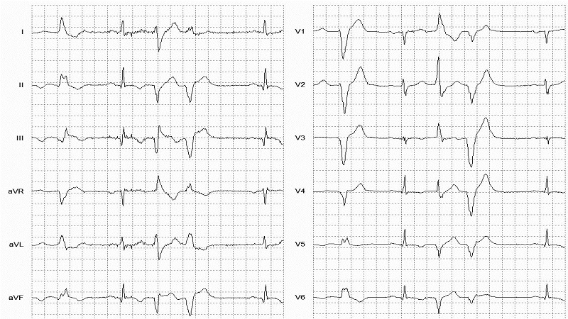 VEB Couplets 12 Lead EKG